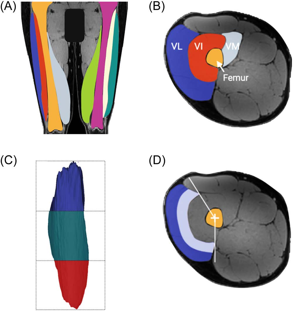 Intramuscular Fat and Quadriceps Atrophy